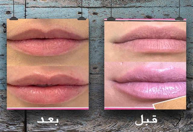 جمالك بيزيد مع  Lip Filler